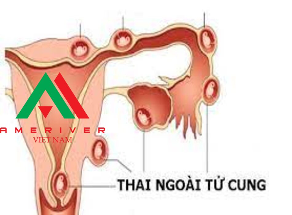 Thai ngoài tử cung: Điều trị ngoại khoa